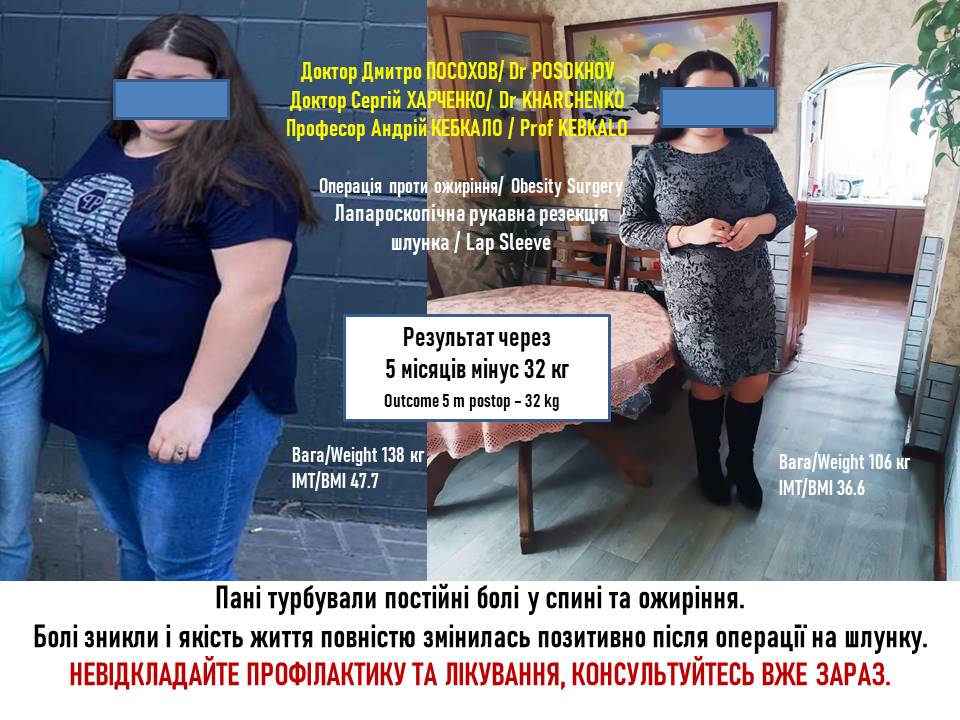 Лапароскопічна рукавна резекція – результат